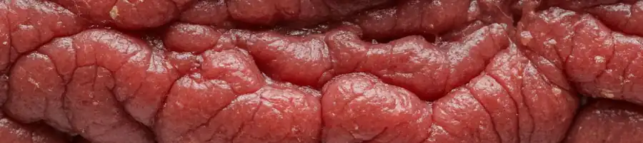 Фридрейха болезнь как термин энциклопедии по психиатрии