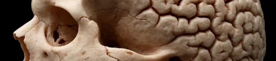 Фронтальный гиперостоз как термин энциклопедии по психиатрии